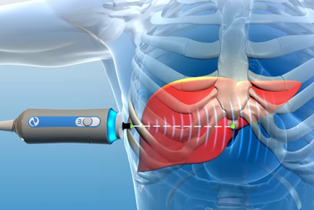 Fibroscan.jpg