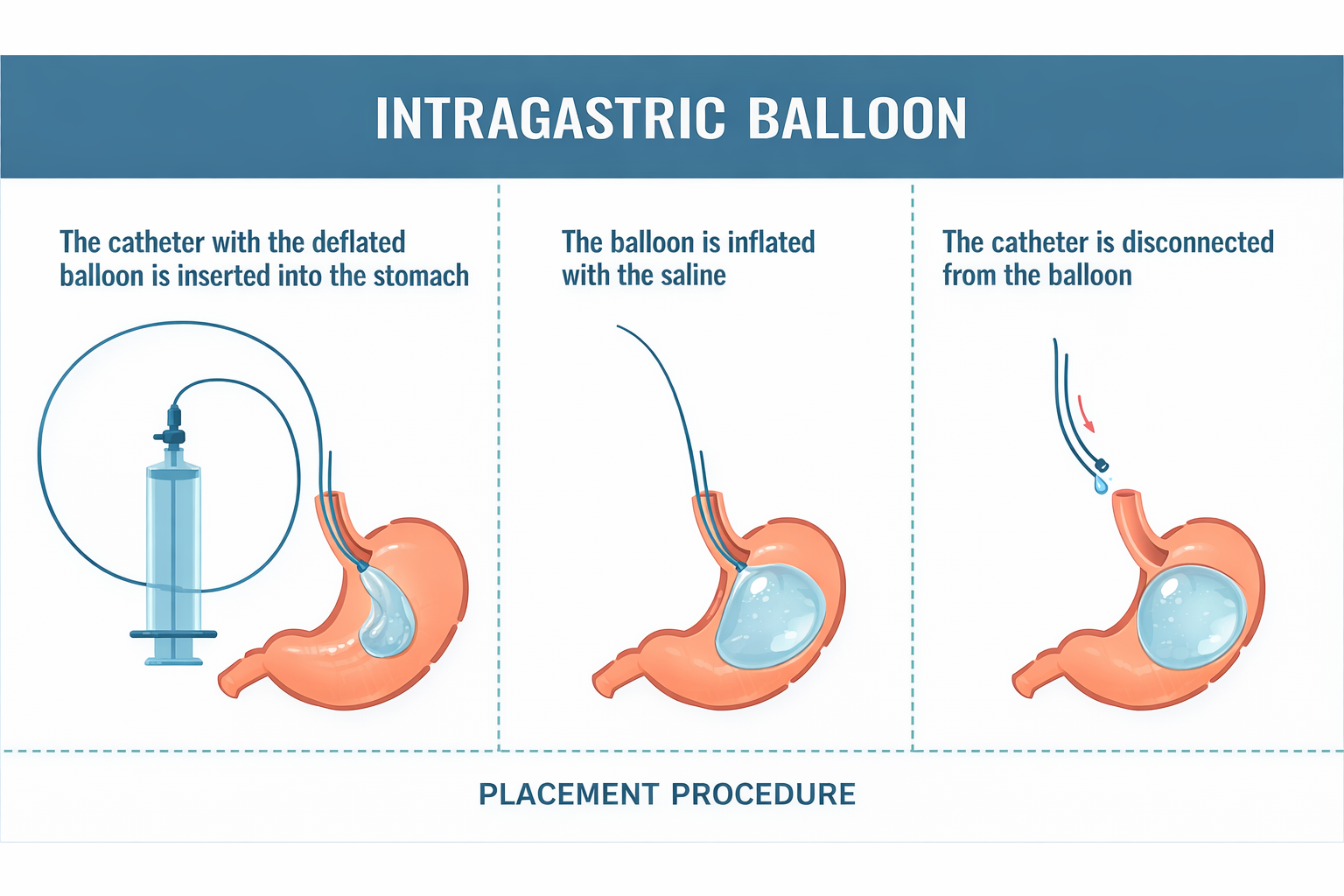 Placement procedure