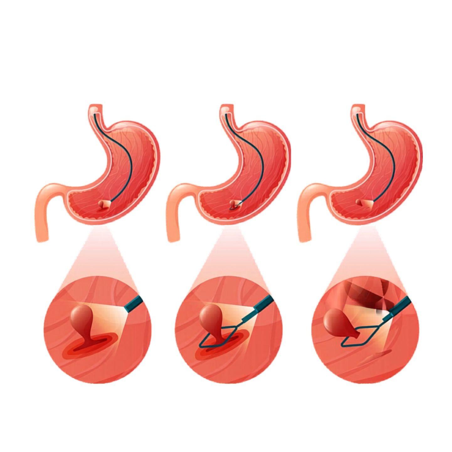 endoscopic-polypectomy