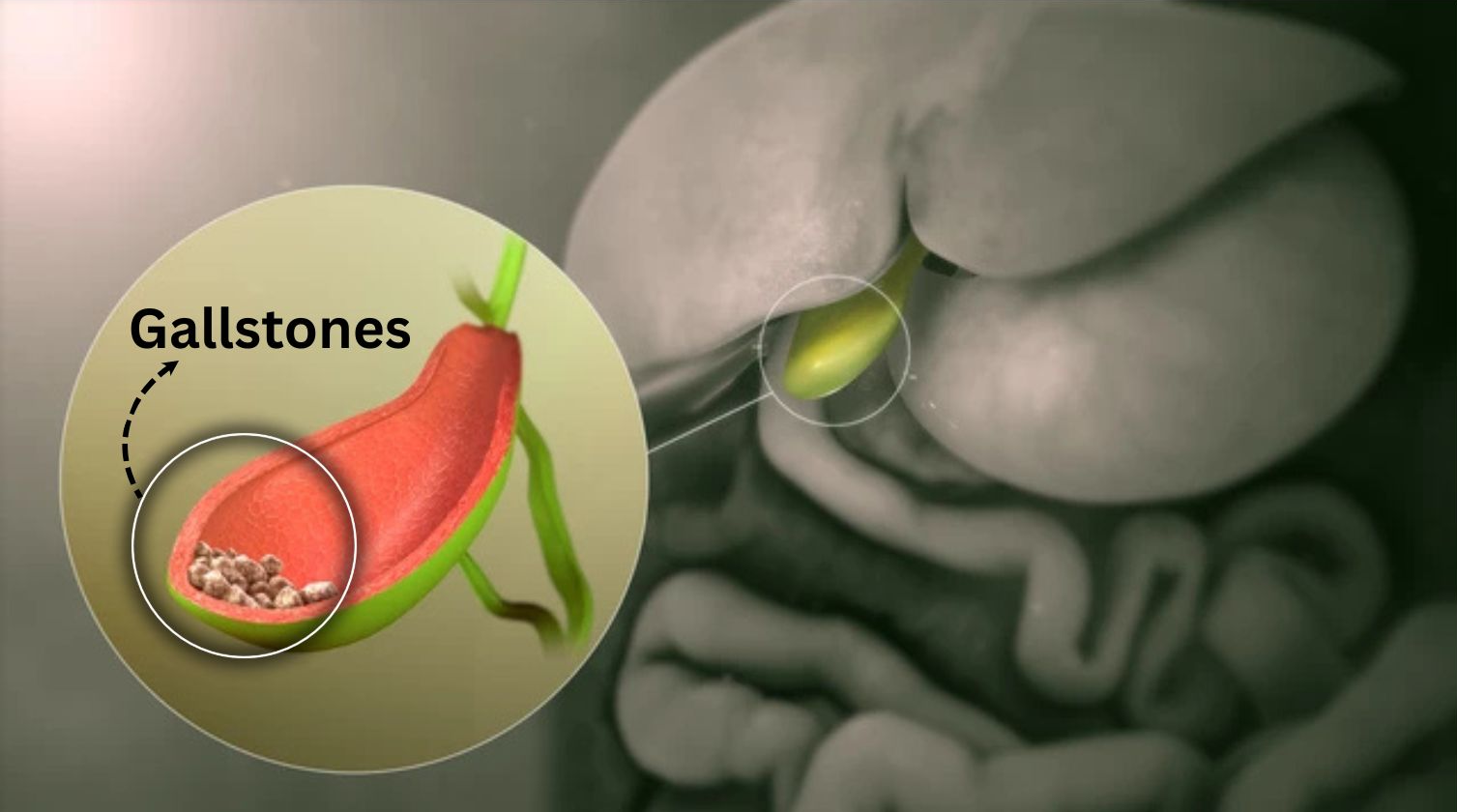 gallbladder.jpg
